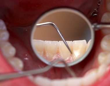 Mulut Berbau Disebabkan Oleh Karang Gigi? Ini Petua Menyingkirkan Plak Gigi Dan Cara Mencegahnya!