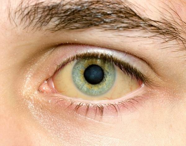 Inilah 10 Keadaan Mata Yang Menunjukkan Masalah Kesihatan 