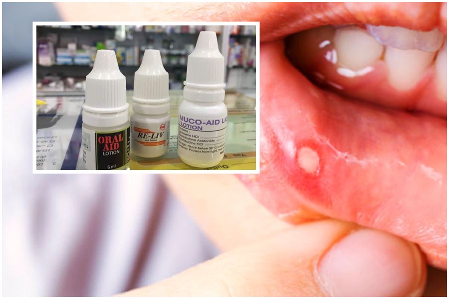 Ini Cadangan UbatUbat Merawat Ulser Mulut Menurut Kata Doktor  Petua Ibu